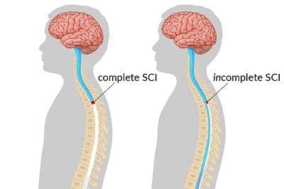odds of being paralyzed by chiropractor|Risk of Traumatic Injury Associated with Chiropractic Spinal .